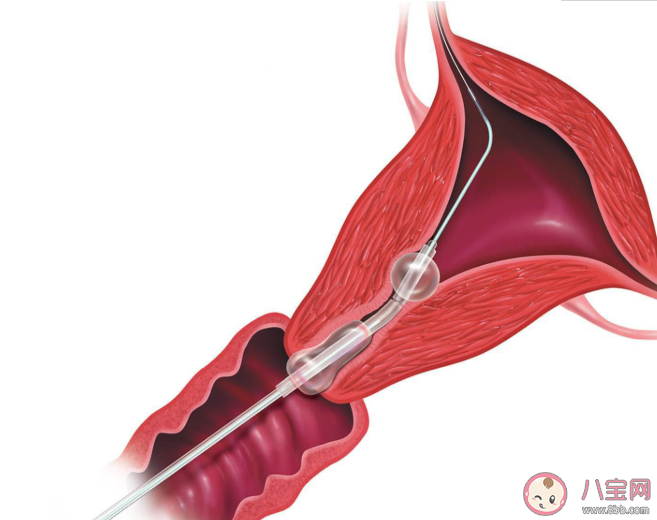 輸卵管粘連還能自然受孕嗎 輸卵管粘連怎么治療最有效 輸卵管粘連還能自然受孕嗎 輸卵管粘連怎么治療最有效