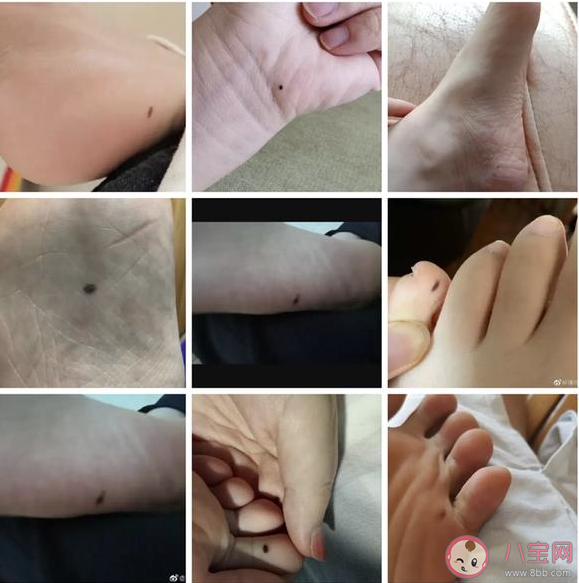 腳底有痣一定要切除嗎 惡性黑色素瘤哪些部位容易多發 腳底有痣一定要切除嗎 惡性黑色素瘤哪些部位容易多發