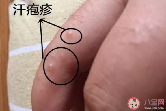 夏天手上愛長水泡是怎么回事 夏天手上長的小水泡是什么 夏天手上愛長水泡是怎么回事 夏天手上長的小水泡是什么