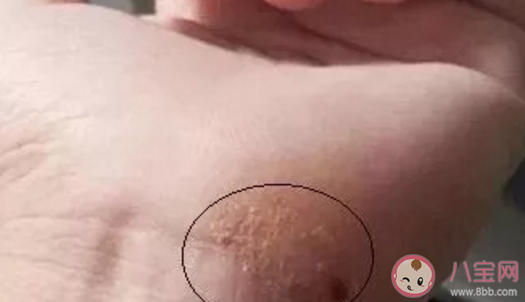 夏天手上愛長水泡是怎么回事 夏天手上長的小水泡是什么 夏天手上愛長水泡是怎么回事 夏天手上長的小水泡是什么