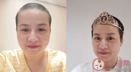 岳云鵬老婆為什么剃光頭 剃光頭是得了什么病