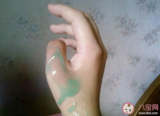 孩子燒燙傷可以用牙膏嗎 遇到寶寶燙傷燒燙傷怎么辦 孩子燒燙傷可以用牙膏嗎 遇到寶寶燙傷燒燙傷怎么辦