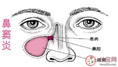 孩子鼻竇炎急性和慢性的區(qū)別 鼻竇炎用什么藥好 孩子鼻竇炎急性和慢性的區(qū)別 鼻竇炎用什么藥好