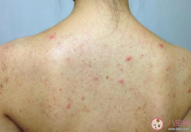 后背長痘怎么消除 后背長痘消除方法 后背長痘怎么消除 后背長痘消除方法