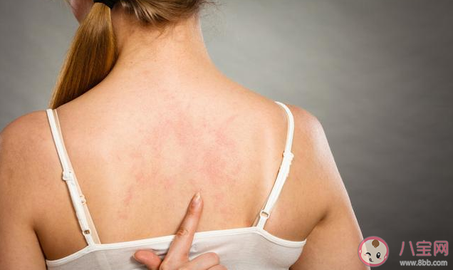 后背長痘怎么消除 后背長痘消除方法 后背長痘怎么消除 后背長痘消除方法