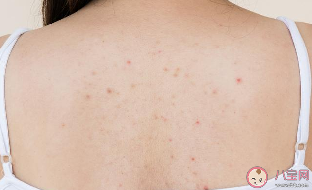 后背長痘怎么消除 后背長痘消除方法 后背長痘怎么消除 后背長痘消除方法