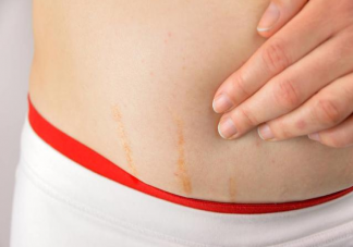 孕期肚子小不會長妊娠紋嗎 妊娠紋和肚子大小有關(guān)嗎
