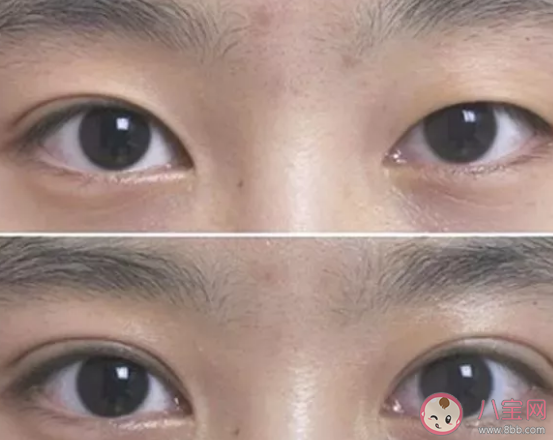 哪些人不能做去腫眼泡手術(shù)呢 去腫眼泡手術(shù)有副作用嗎。 哪些人不能做去腫眼泡手術(shù)呢 去腫眼泡手術(shù)有副作用嗎。