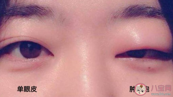 哪些人不能做去腫眼泡手術(shù)呢 去腫眼泡手術(shù)有副作用嗎。 哪些人不能做去腫眼泡手術(shù)呢 去腫眼泡手術(shù)有副作用嗎。