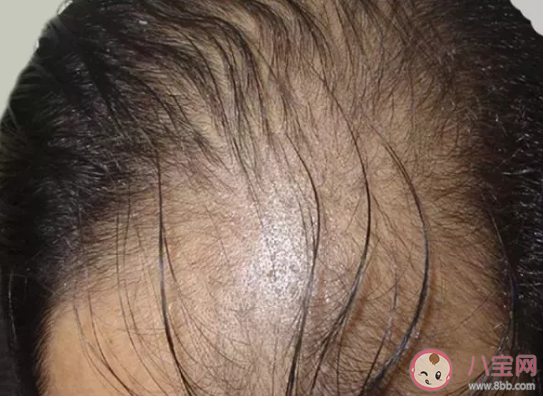 男性禿頭與性生活過度有關系嗎 男性禿頭是什么原因造成的