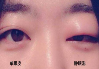 哪些人不能做去腫眼泡手術(shù)呢 去腫眼泡手術(shù)有副作用嗎。