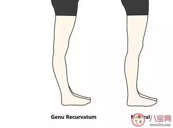 膝蓋不直膝蓋超伸怎么改正 不胖腿粗怎么辦 膝蓋不直膝蓋超伸怎么改正 不胖腿粗怎么辦