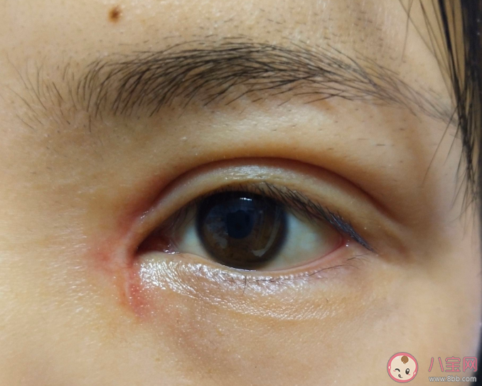 開眼角可以改善哪些眼部問題 開眼角有什么好處