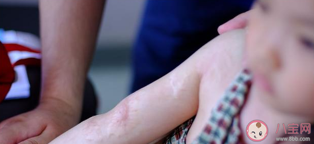 暑假最常見的兒童意外傷害 暑假意外急救指南 暑假最常見的兒童意外傷害 暑假意外急救指南