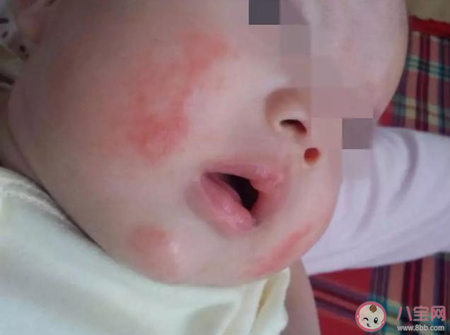 寶寶濕疹涂藥膏怎么涂 濕疹涂藥膏正確方法 寶寶濕疹涂藥膏怎么涂 濕疹涂藥膏正確方法