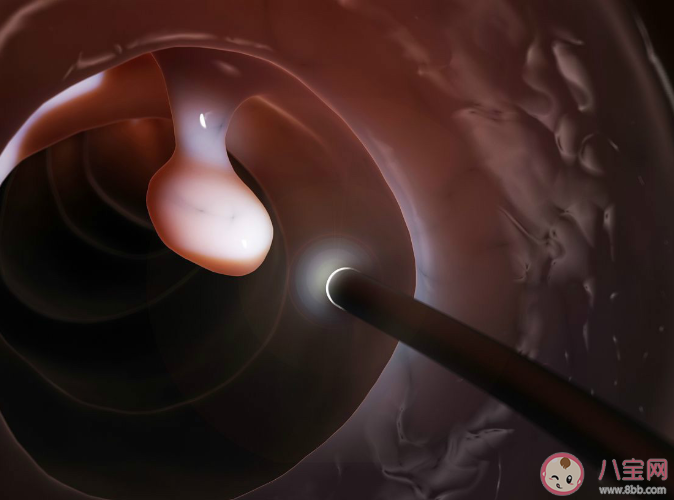 宮頸息肉會影響女性懷孕嗎 日常如何預防宮頸息肉 宮頸息肉會影響女性懷孕嗎 日常如何預防宮頸息肉