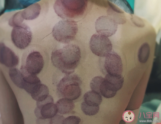 人生中第一次拔罐的說說 拔罐的搞笑句子