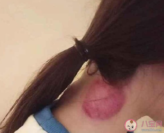 人生中第一次拔罐的說說 拔罐的搞笑句子