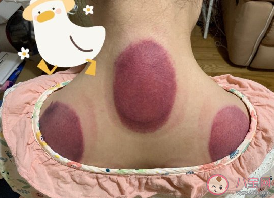 人生中第一次拔罐的說說 拔罐的搞笑句子