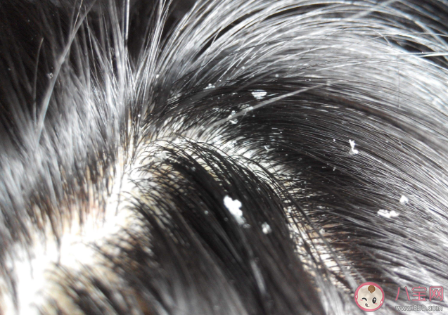 為什么會產生頭皮屑 如何有效清理頭皮屑