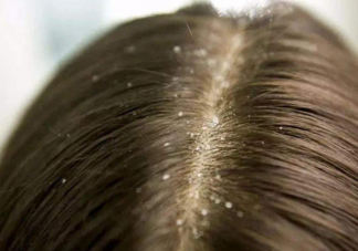 為什么會產(chǎn)生頭皮屑 如何有效清理頭皮屑
