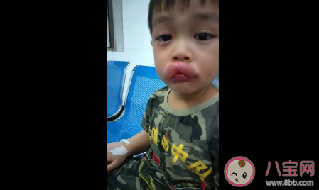 男孩吃葡萄過敏怎么回事 孩子過敏了怎么處理