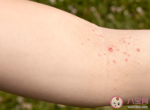 吃了小龍蝦過敏了怎樣做可以消癢 吃小龍蝦過敏怎么辦才最有 吃了小龍蝦過敏了怎樣做可以消癢 吃小龍蝦過敏怎么辦才最有