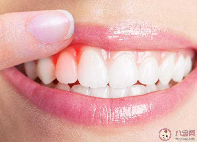 牙齦腫脹很難受怎么辦 牙齦腫脹難受緩解方法
