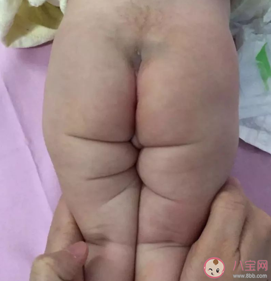 寶寶臀紋不對稱一定是有問題嗎 臀紋不對稱是不是髖關節發育不良