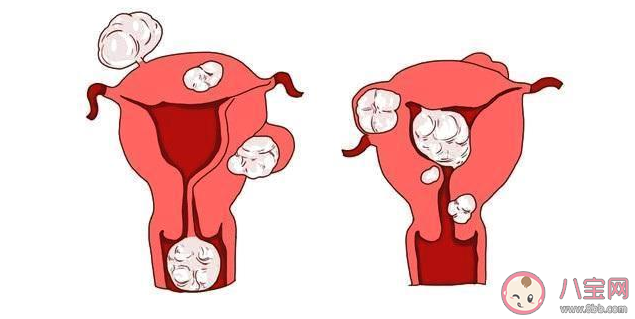 子宮肌瘤和子宮腺肌瘤有什么區別 子宮肌瘤和子宮腺肌瘤一樣嗎 子宮肌瘤和子宮腺肌瘤有什么區別 子宮肌瘤和子宮腺肌瘤一樣嗎