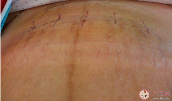 剖腹產會影響受孕率嗎 剖腹產為什么會導致受孕率下降