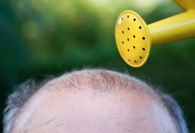 溢脂性脫發能自愈嗎 必須天天洗頭嗎