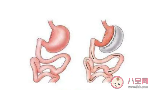 患了糖尿病進行切胃手術有用嗎 切胃手術會不會導致身體后遺癥