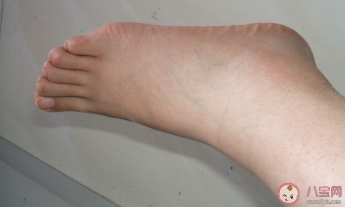 孕期腿腳水腫怎么緩解不適 緩解腿腳水腫的方法 孕期腿腳水腫怎么緩解不適 緩解腿腳水腫的方法