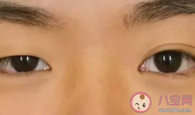 如何看待高考生扎堆割雙眼皮 割雙眼皮真能變漂亮嗎 如何看待高考生扎堆割雙眼皮 割雙眼皮真能變漂亮嗎