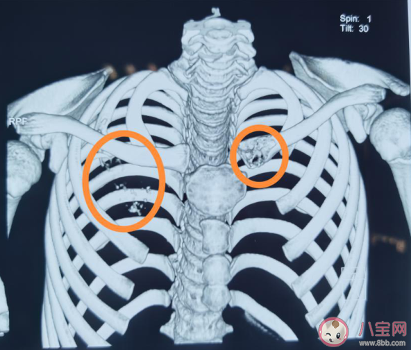 12歲男孩確診肺癌晚期是怎么回事 小小年紀(jì)為什么會(huì)得肺癌