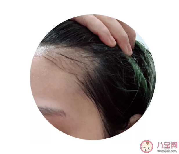 禿頭的前兆是什么 判斷是不是要脫發(fā)的幾種方法