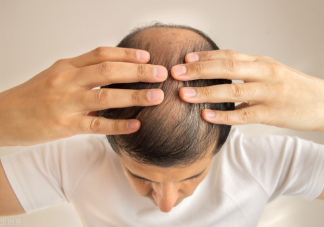 禿頭的前兆是什么 判斷是不是要脫發的幾種方法