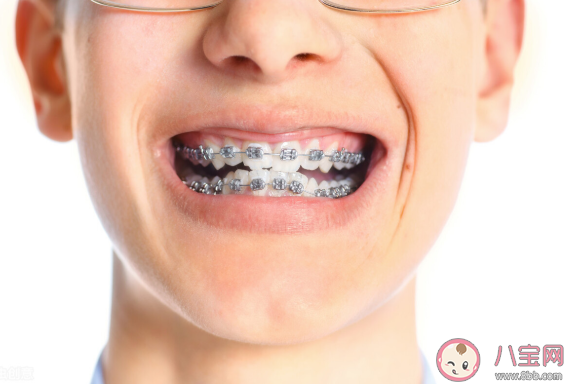 矯正牙齒對臉型的影響大嗎 哪幾類人牙齒矯正臉型變化最大