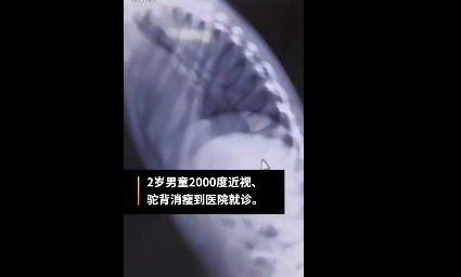 2歲男童近視兩千多度怎么回事 馬凡綜合征是什么