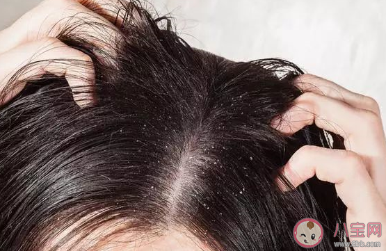 自己的頭發頭皮癢頭皮屑多有可能傳染嗎 支付寶螞蟻莊園11月19日問題答案更新