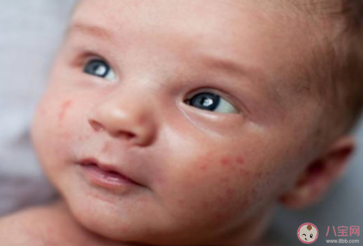 剖腹產(chǎn)的孩子更容易哮喘過(guò)敏嗎 如何預(yù)防過(guò)敏引發(fā)的哮喘