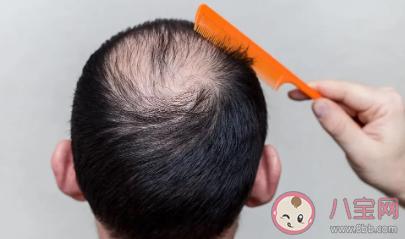 專家教你如何自測脫發程度 辨別脫發是生理性還是病理性
