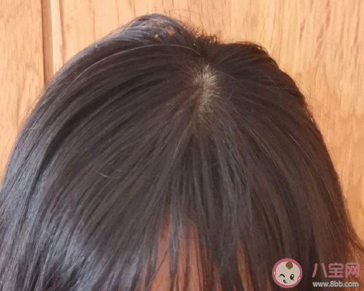 人到中年脫發嚴重心情說說  調侃脫發搞笑句子大全