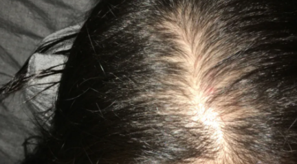 年輕人吃什么可以防脫發 年輕人防脫發飲食建議