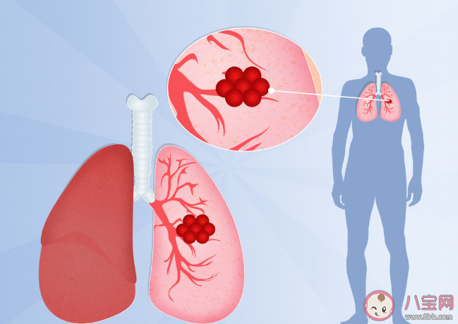 肺結(jié)核體檢結(jié)果將納入學(xué)生健康檔案 ?為什么要納入學(xué)生健康檔案