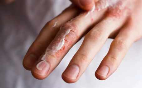 兒科醫生每天洗手超100次是為什么 洗手次數太多的危害