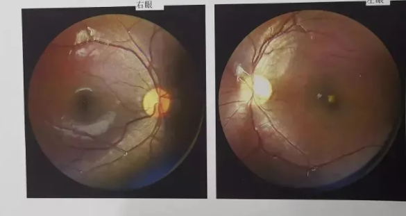 9歲孩子玩激光筆左眼失明怎么回事 激光筆對眼睛的危害 9歲孩子玩激光筆左眼失明怎么回事 激光筆對眼睛的危害