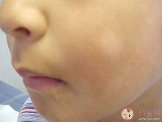 寶寶臉上一小塊泛白是什么病 寶寶臉上一小塊泛白怎么回事