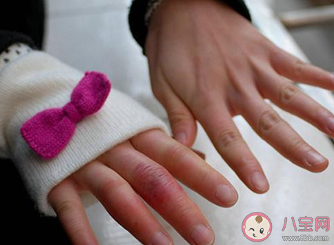 用醋能不能治療凍瘡 臉部凍瘡是怎么回事 用醋能不能治療凍瘡 臉部凍瘡是怎么回事